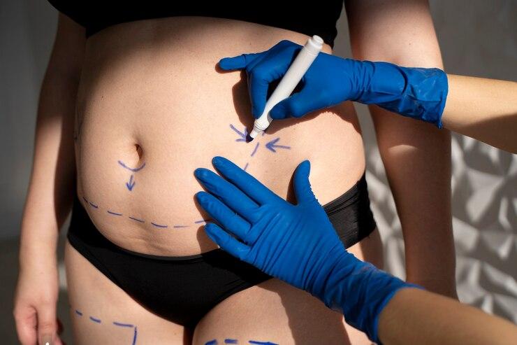 Lipoaspiração