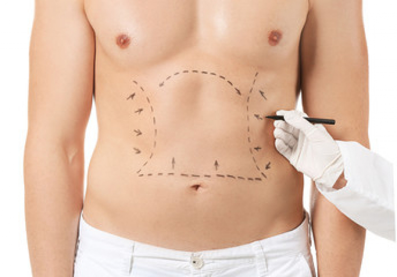 Abdominoplastia em Homem Preço Ananindeua Centro - Abdominoplastia Hd
