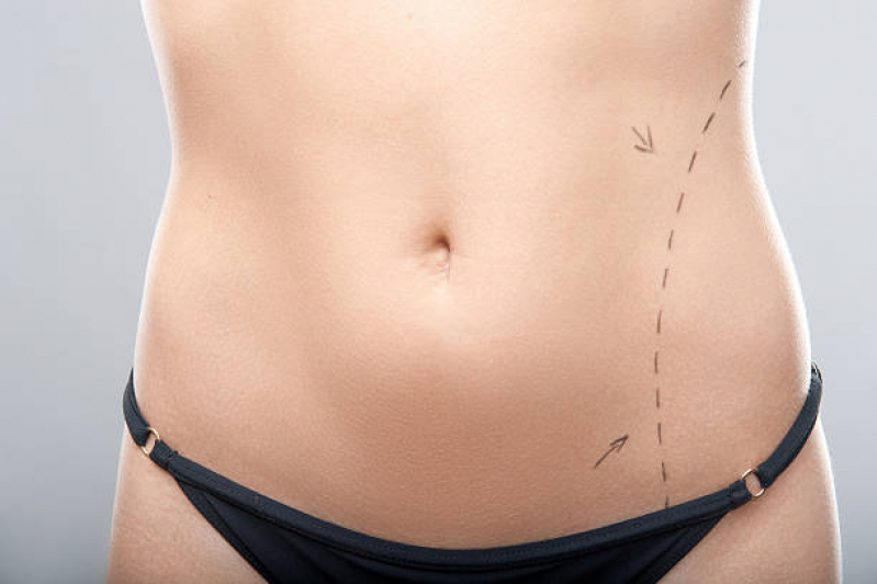 Cirurgia da Barriga Abdominoplastia Ferreira Gomes - Cirurgia para Retirar Gordura da Barriga