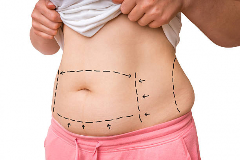 Cirurgia de Abdominoplastia Preço Santa Lídia - Cirurgia para Retirar Gordura da Barriga