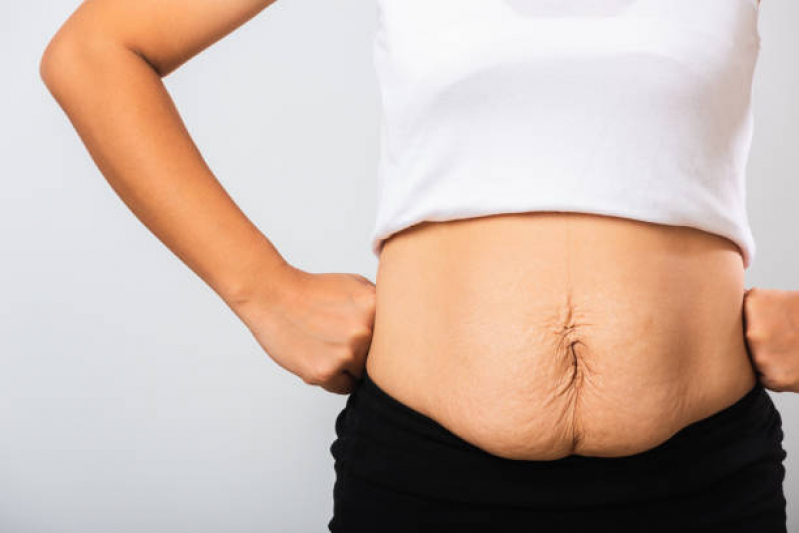 Cirurgia na Barriga Abdominoplastia Rouxinol - Cirurgia para Retirar Gordura da Barriga