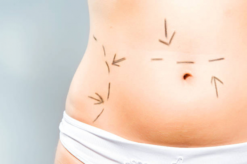 Cirurgia para Retirar Gordura da Barriga Umarizal - Cirurgia de Abdominoplastia