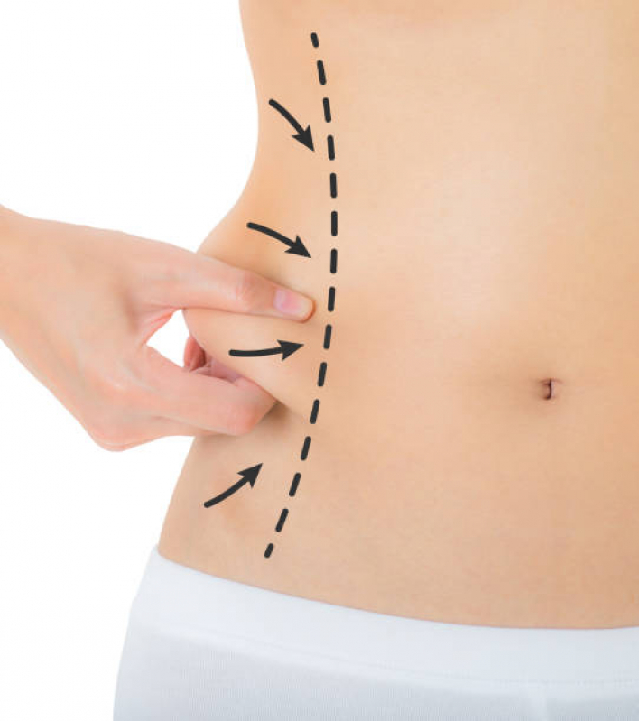 Cirurgia Plástica Abdominoplastia Preço Heliolândia - Cirurgia para Retirar Gordura da Barriga
