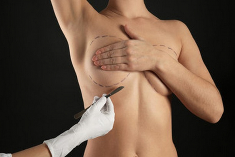 Cirurgia Redução de Mama Condor - Cirurgia de Redução de Peito