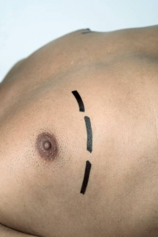 Ginecomastia e Lipomastia Valor Saudade - Ginecomastia Bilateral Masculina
