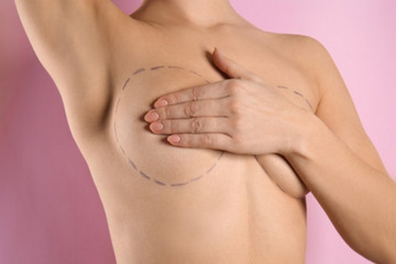 Preço de Cirurgia Redução de Mama Maguari - Cirurgia de Redução de Peito