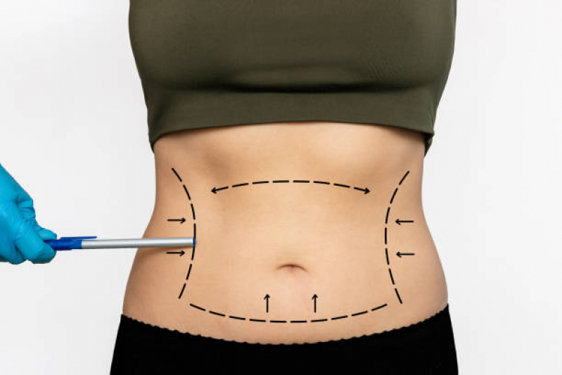 Qual o Valor de Cirurgia da Barriga Abdominoplastia Montese - Cirurgia para Retirar Gordura da Barriga