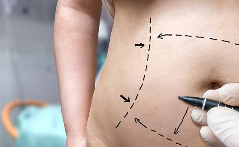 Qual o Valor de Cirurgia de Abdominoplastia Jaderlândia - Cirurgia para Retirar Gordura da Barriga