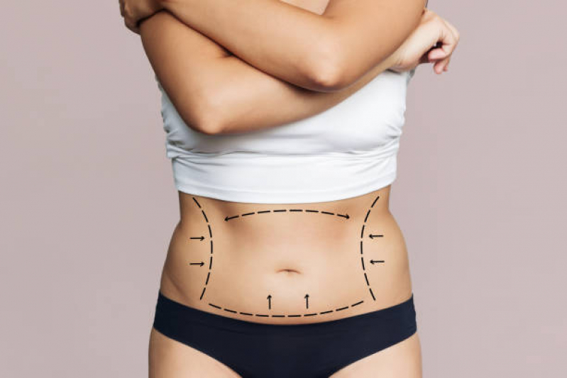 Qual o Valor de Cirurgia para Retirar Gordura da Barriga Coqueiro - Cirurgia de Abdominoplastia