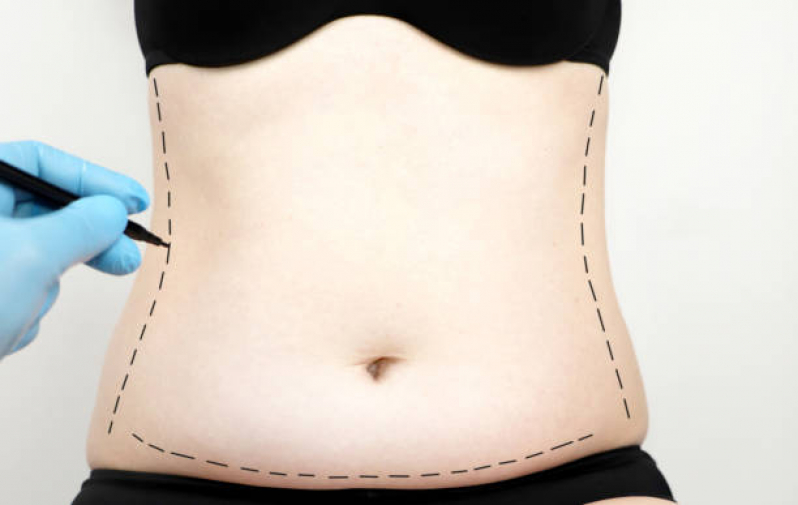 Qual o Valor de Cirurgia Plástica Abdominoplastia Cidade Nova - Cirurgia para Retirar Gordura da Barriga