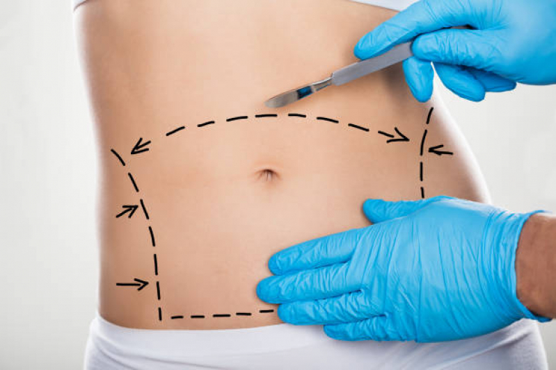 Qual o Valor de Cirurgia Retirada de Pele da Barriga Novo Estrela - Cirurgia Plástica Abdominoplastia