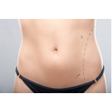 cirurgia da barriga abdominoplastia Águas Brancas