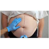 cirurgia de abdominoplastia Nazaré